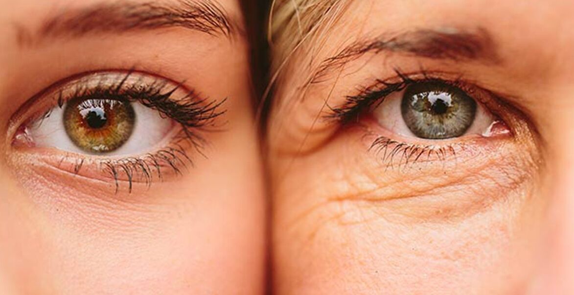 สัญญาณภายนอกของริ้วรอยผิวรอบดวงตาในผู้หญิงสองคนที่มีอายุต่างกัน